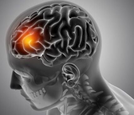 Waspada 5 Jenis Disabilitas yang dimaksud Sering Dialami Pasien Stroke
