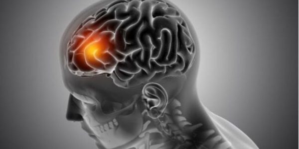 Waspada 5 Jenis Disabilitas yang dimaksud Sering Dialami Pasien Stroke