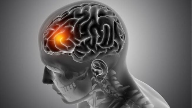Waspada 5 Jenis Disabilitas yang dimaksud Sering Dialami Pasien Stroke