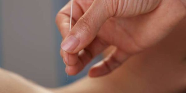 2 Manfaat Terapi Akupuntur Usai Serangan Stroke, Bisa Cegah Kecacatan?